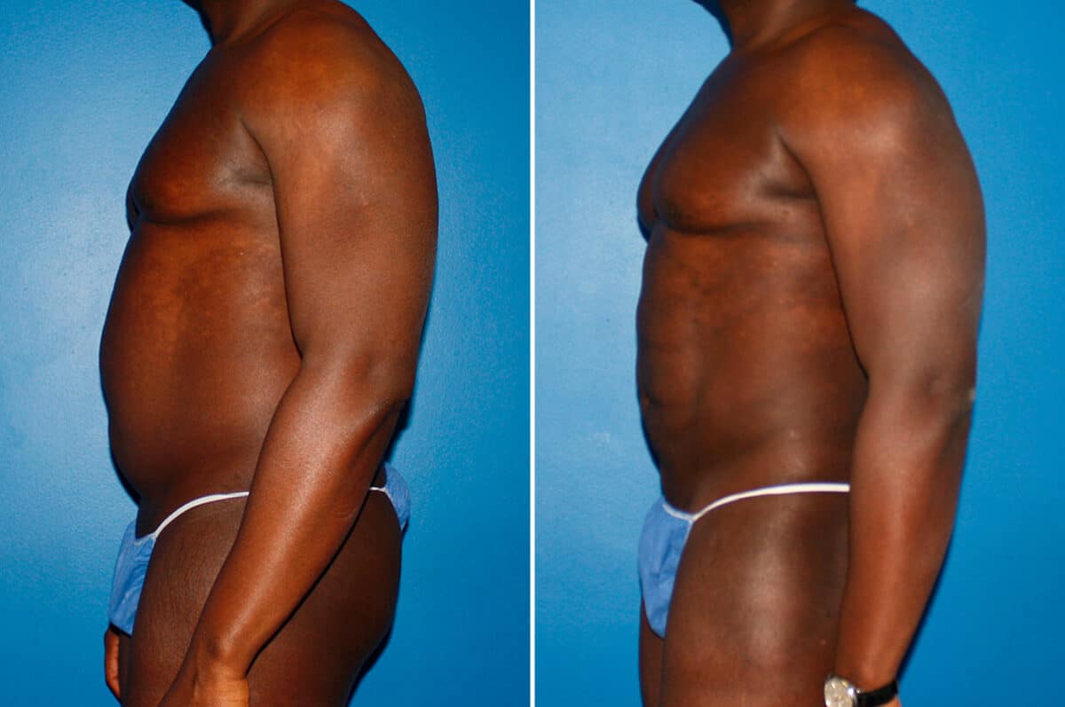 Coolsculpting Before and After Photos in New York, NY, Patient 14167