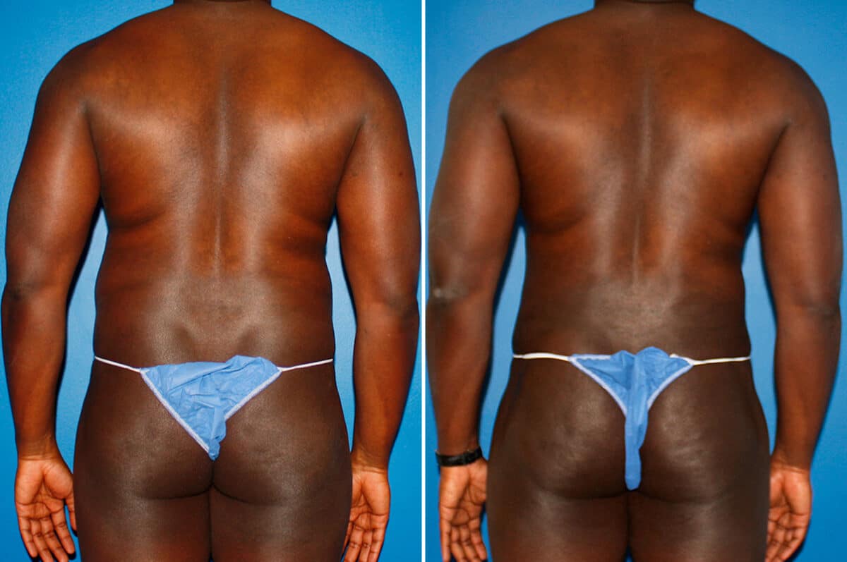 Coolsculpting Before and After Photos in New York, NY, Patient 14167