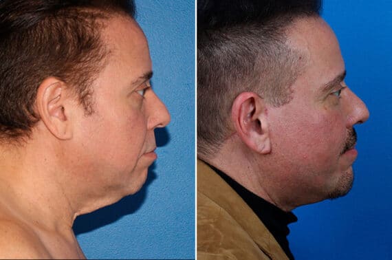 Facelift Before and After Photos in New York, NY, Patient 15432