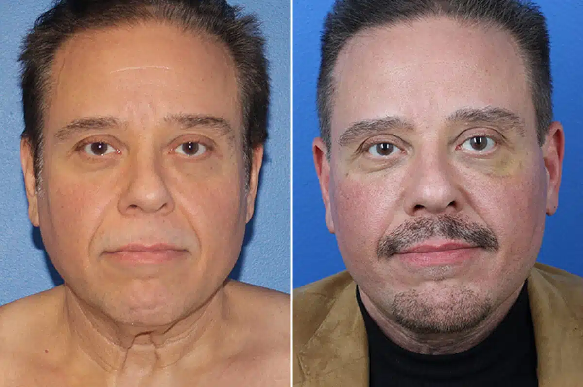 Facelift Before and After Photos in New York, NY, Patient 15432