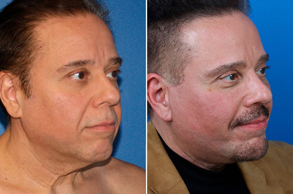 Facelift Before and After Photos in New York, NY, Patient 15432