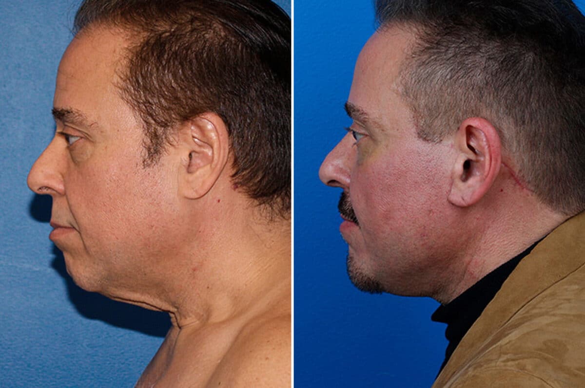 Facelift Before and After Photos in New York, NY, Patient 15432