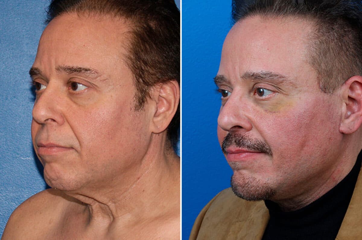 Facelift Before and After Photos in New York, NY, Patient 15432