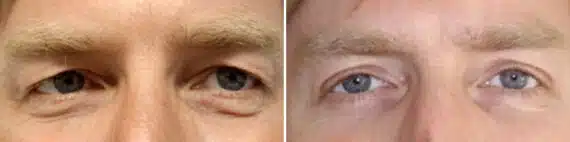 Eyelid Surgery Before and After Photos in New York, NY, Patient 15652