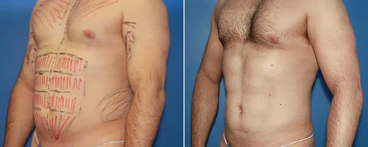 Biceps And Triceps Implants Before and After Photos in New York, NY, Patient 15792