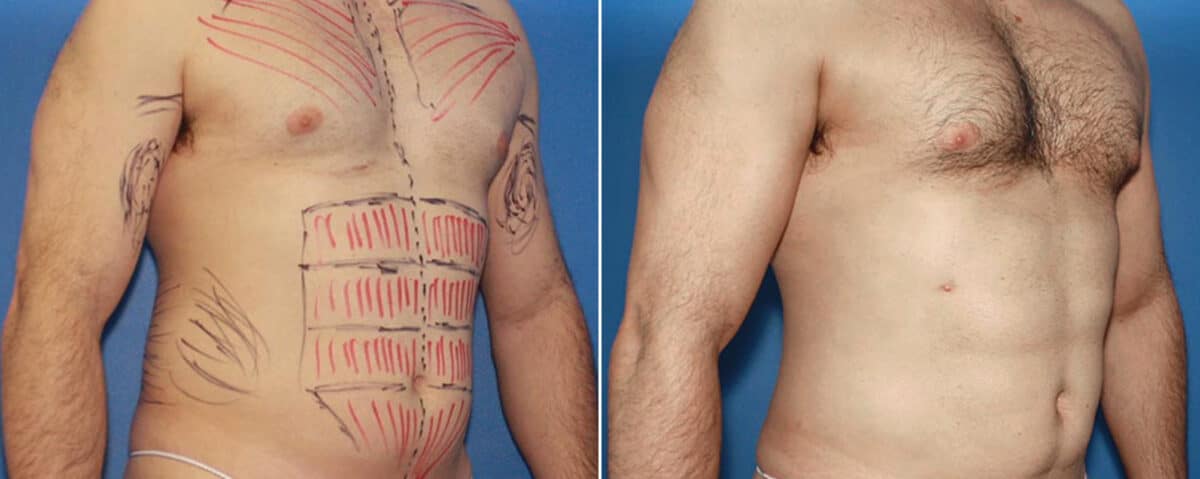 Biceps And Triceps Implants Before and After Photos in New York, NY, Patient 15792