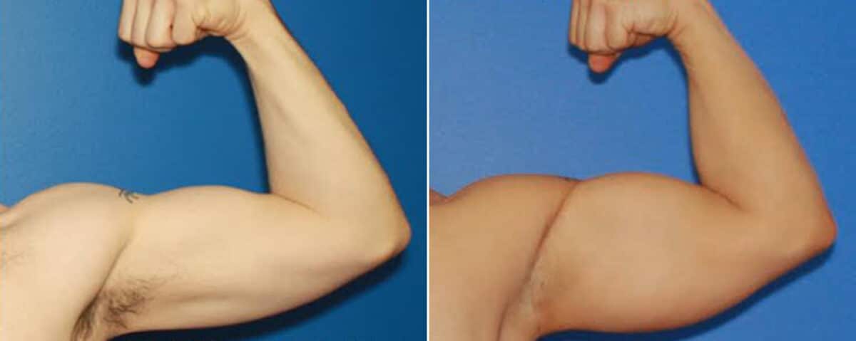 Biceps And Triceps Implants Before and After Photos in New York, NY, Patient 15792
