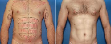 Biceps And Triceps Implants Before and After Photos in New York, NY, Patient 15792