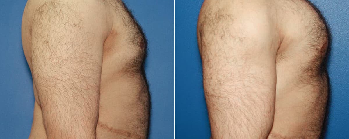 Biceps And Triceps Implants Before and After Photos in New York, NY, Patient 15805