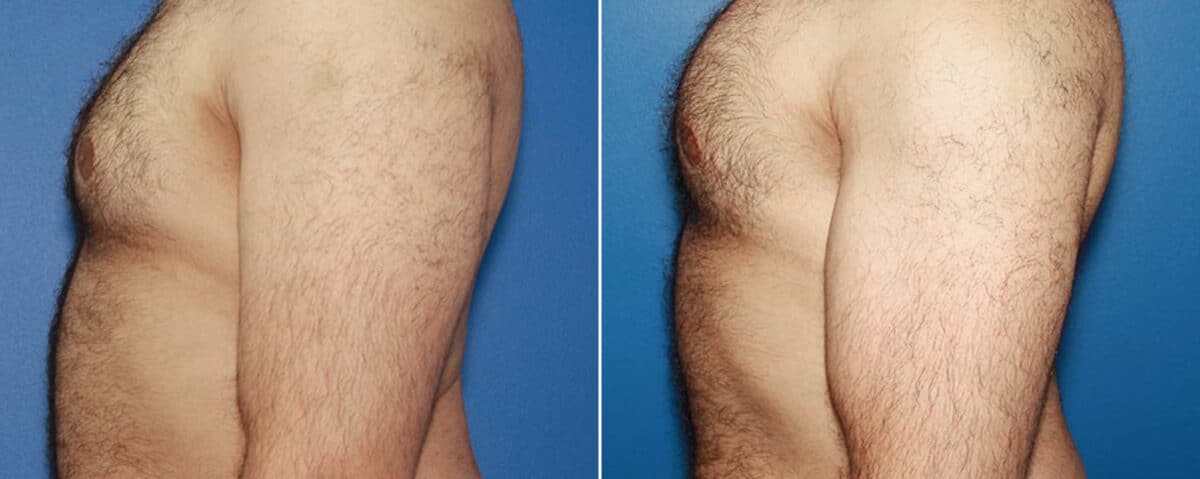 Biceps And Triceps Implants Before and After Photos in New York, NY, Patient 15805