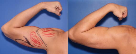 Biceps And Triceps Implants Before and After Photos in New York, NY, Patient 15834