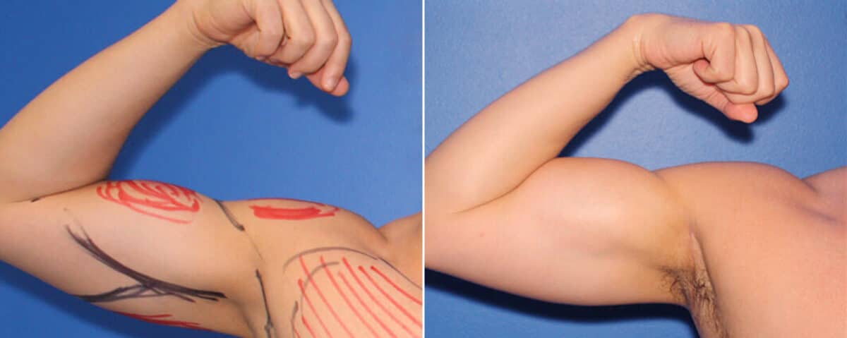 Biceps And Triceps Implants Before and After Photos in New York, NY, Patient 15834