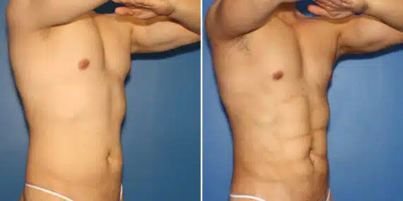 Liposuction Before and After Photos in New York, NY, Patient 16319