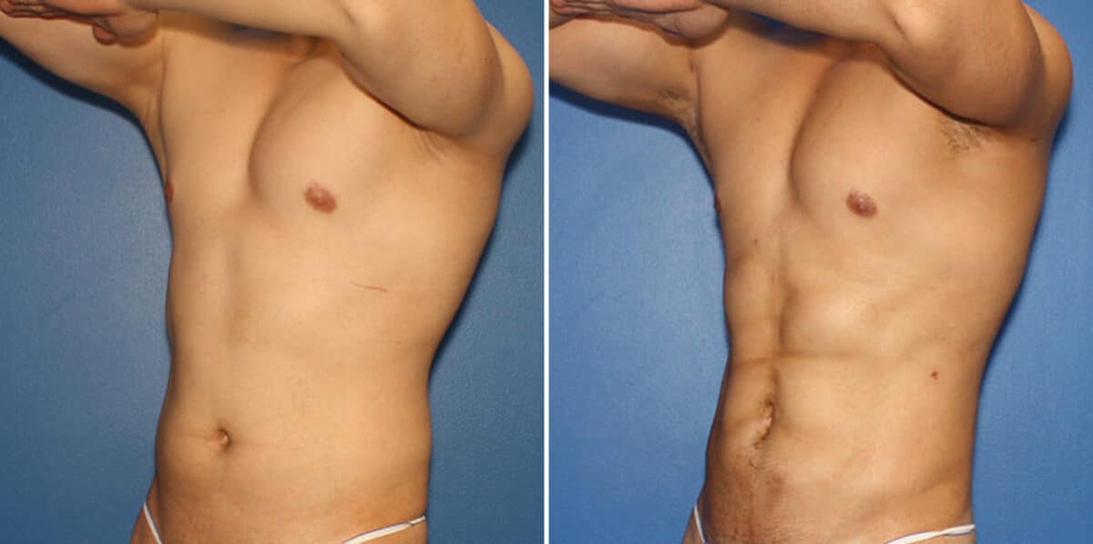Liposuction Before and After Photos in New York, NY, Patient 16319