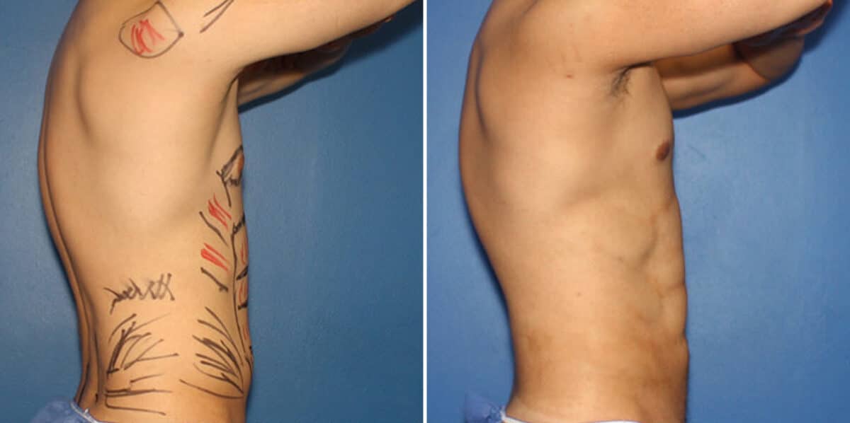 Liposuction Before and After Photos in New York, NY, Patient 16319