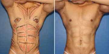 Liposuction Before and After Photos in New York, NY, Patient 16319