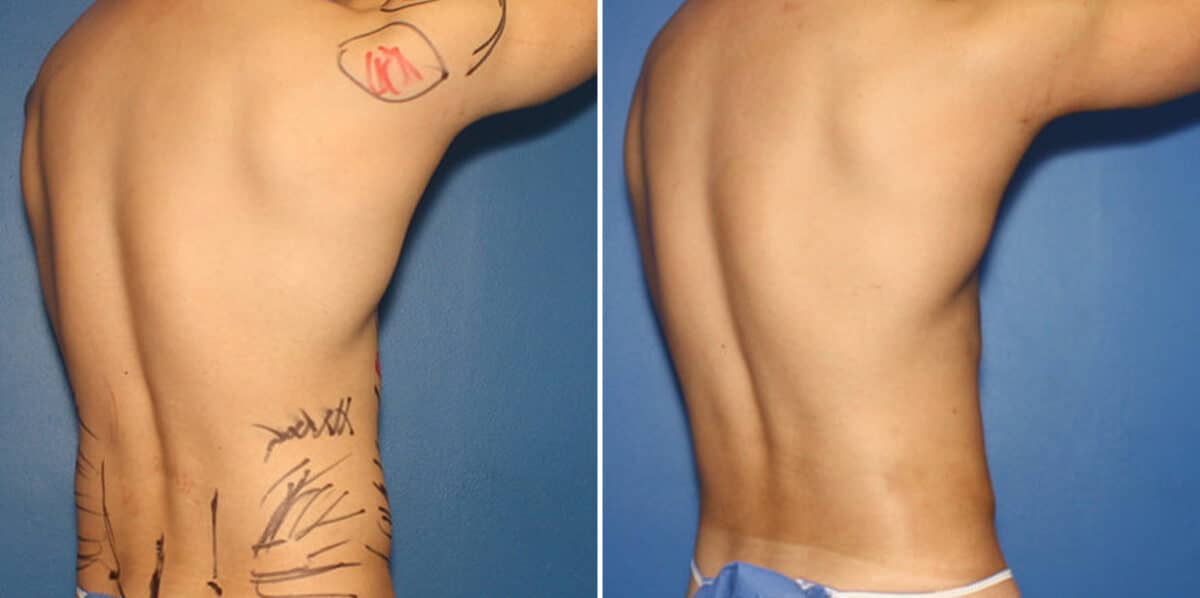 Liposuction Before and After Photos in New York, NY, Patient 16319