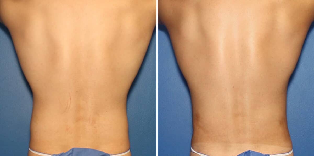 Liposuction Before and After Photos in New York, NY, Patient 16319