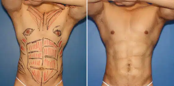 Liposuction Before and After Photos in New York, NY, Patient 16319