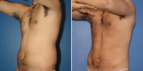 Liposuction Before and After Photos in New York, NY, Patient 16338