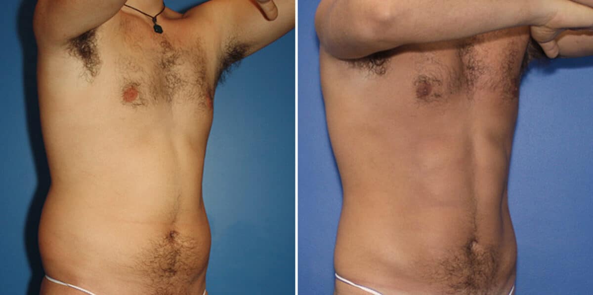 Liposuction Before and After Photos in New York, NY, Patient 16338
