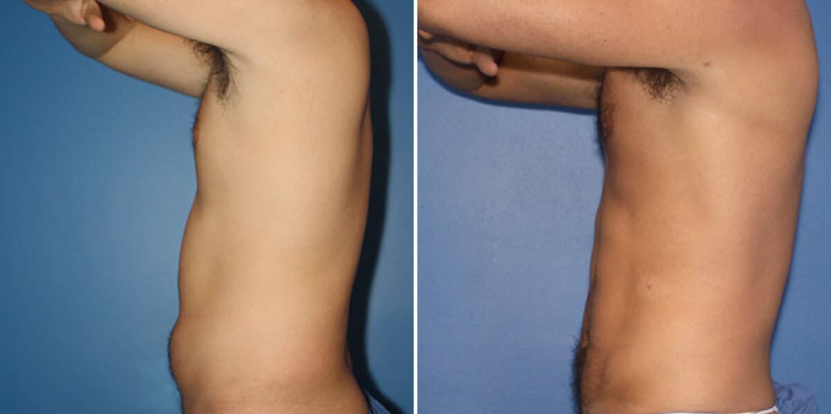 Liposuction Before and After Photos in New York, NY, Patient 16338