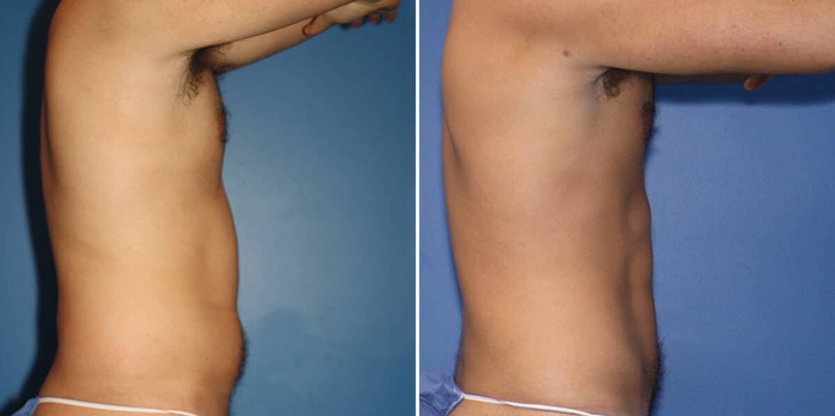 Liposuction Before and After Photos in New York, NY, Patient 16338