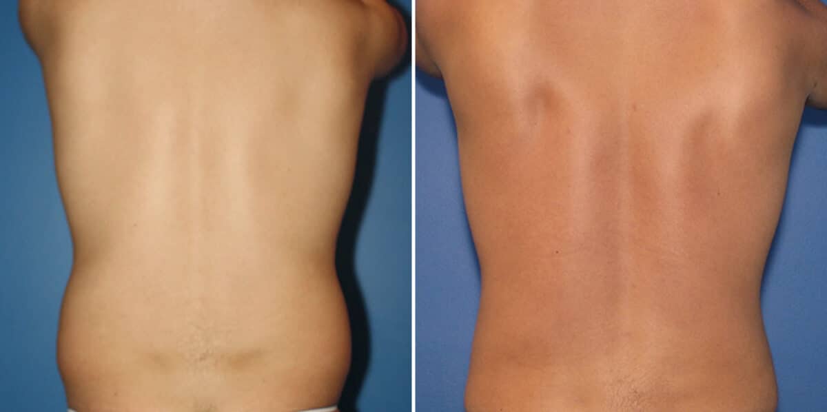Liposuction Before and After Photos in New York, NY, Patient 16338