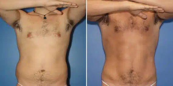 Liposuction Before and After Photos in New York, NY, Patient 16338