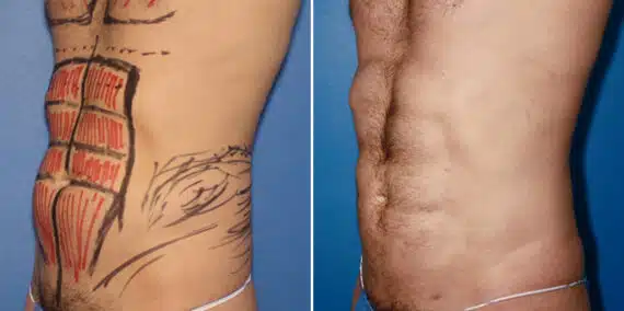Liposuction Before and After Photos in New York, NY, Patient 16379