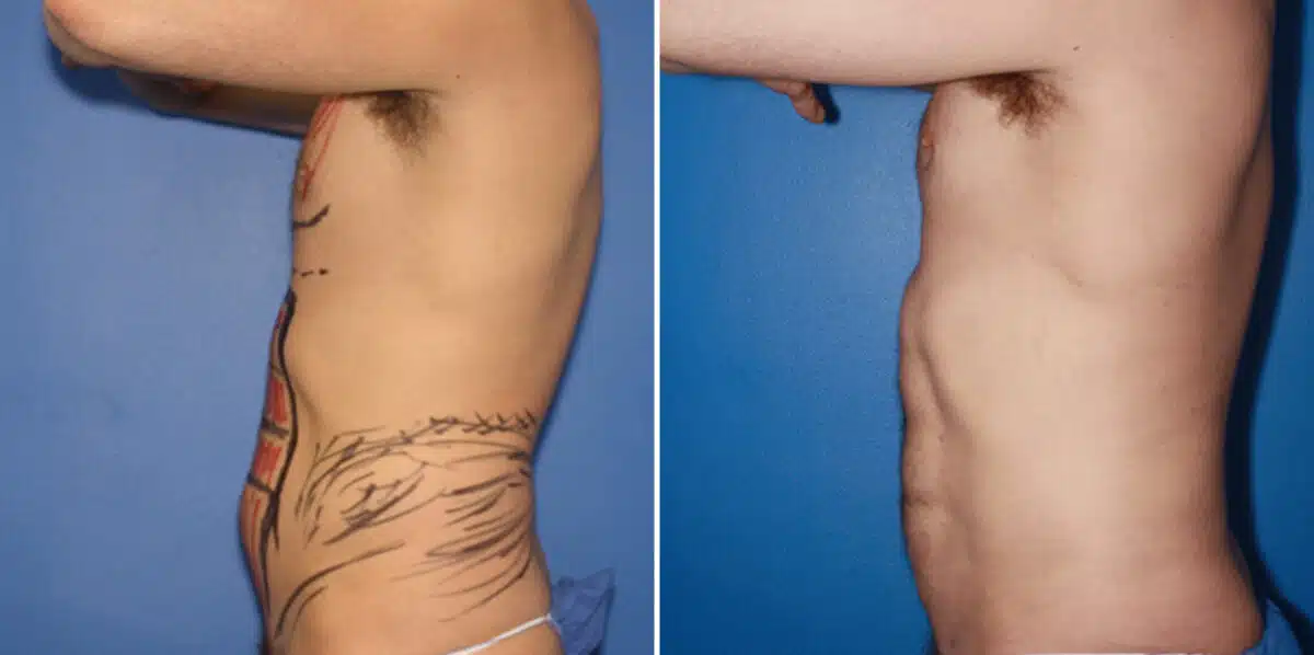 Liposuction Before and After Photos in New York, NY, Patient 16379