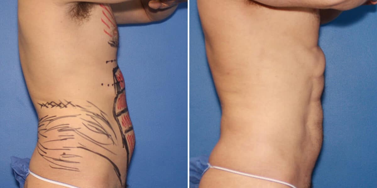 Liposuction Before and After Photos in New York, NY, Patient 16379