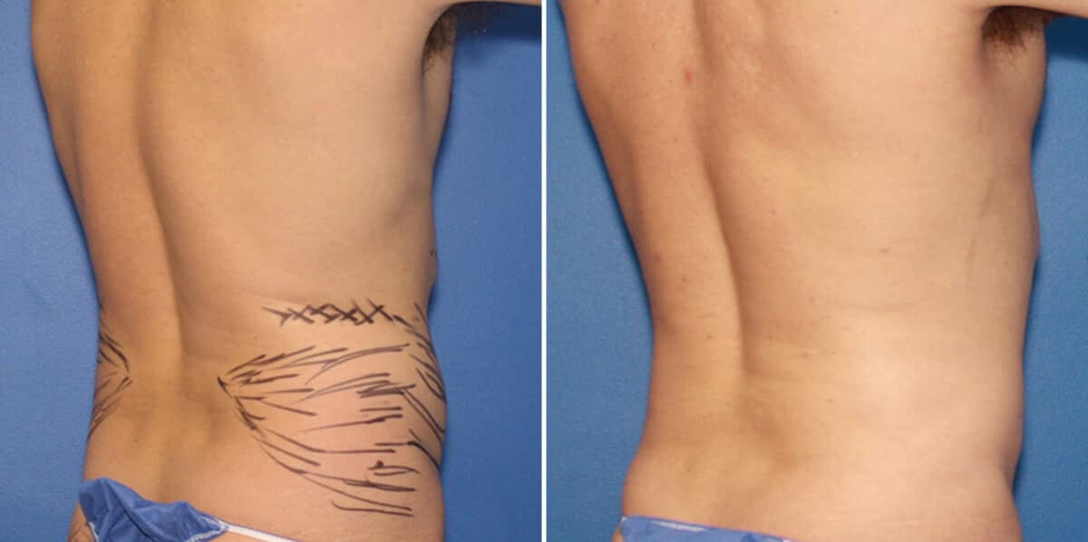 Liposuction Before and After Photos in New York, NY, Patient 16379