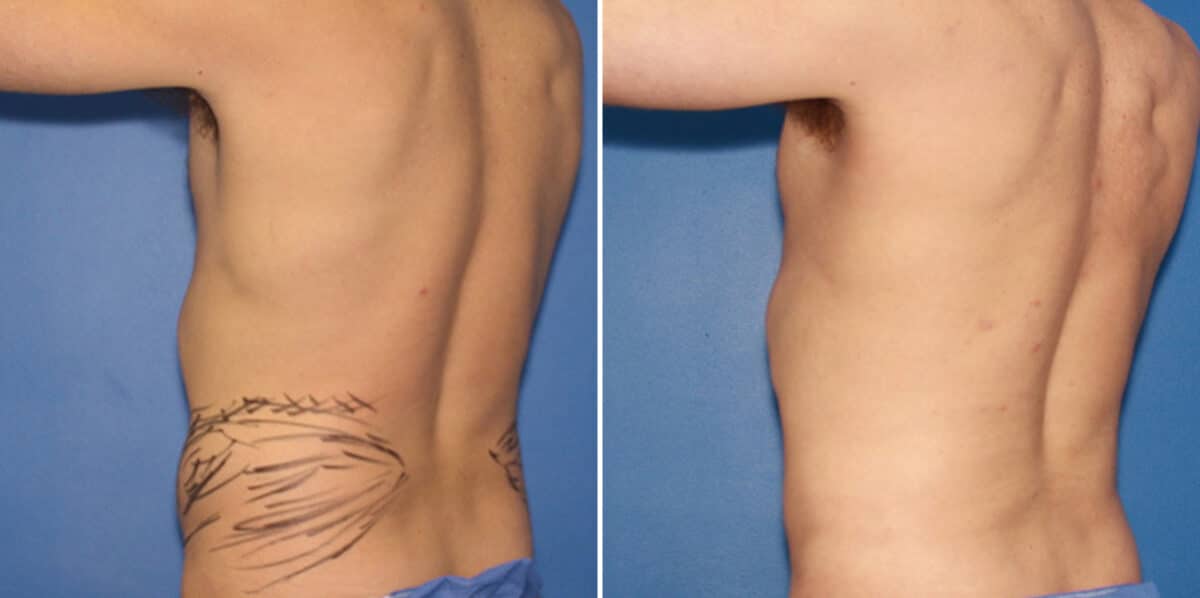 Liposuction Before and After Photos in New York, NY, Patient 16379