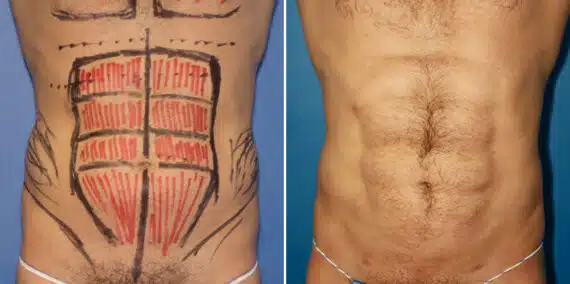 Liposuction Before and After Photos in New York, NY, Patient 16379