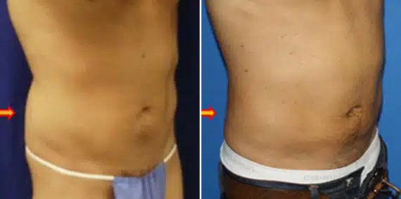 Surfer Abs Before and After Photos in New York, NY, Patient 16447