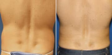 Surfer Abs Before and After Photos in New York, NY, Patient 16447