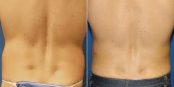 Surfer Abs Before and After Photos in New York, NY, Patient 16447
