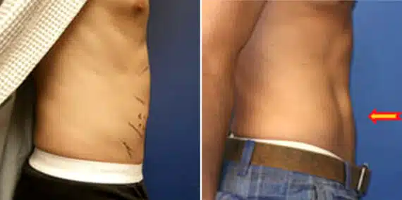 Surfer Abs Before and After Photos in New York, NY, Patient 16454