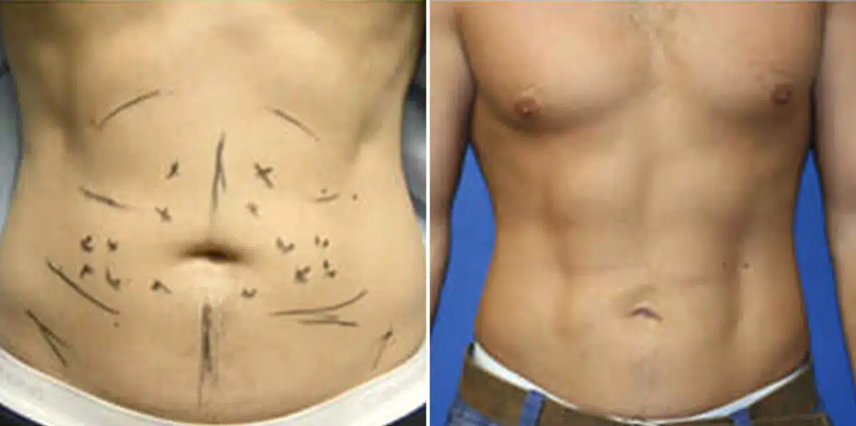 Surfer Abs Before and After Photos in New York, NY, Patient 16454