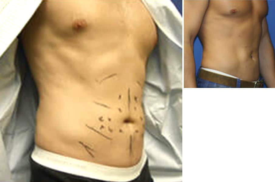 Surfer Abs Before and After Photos in New York, NY, Patient 16454