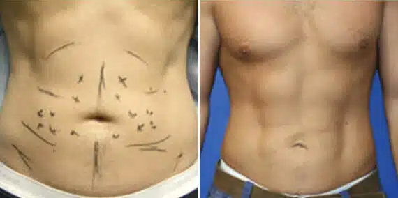 Surfer Abs Before and After Photos in New York, NY, Patient 16454