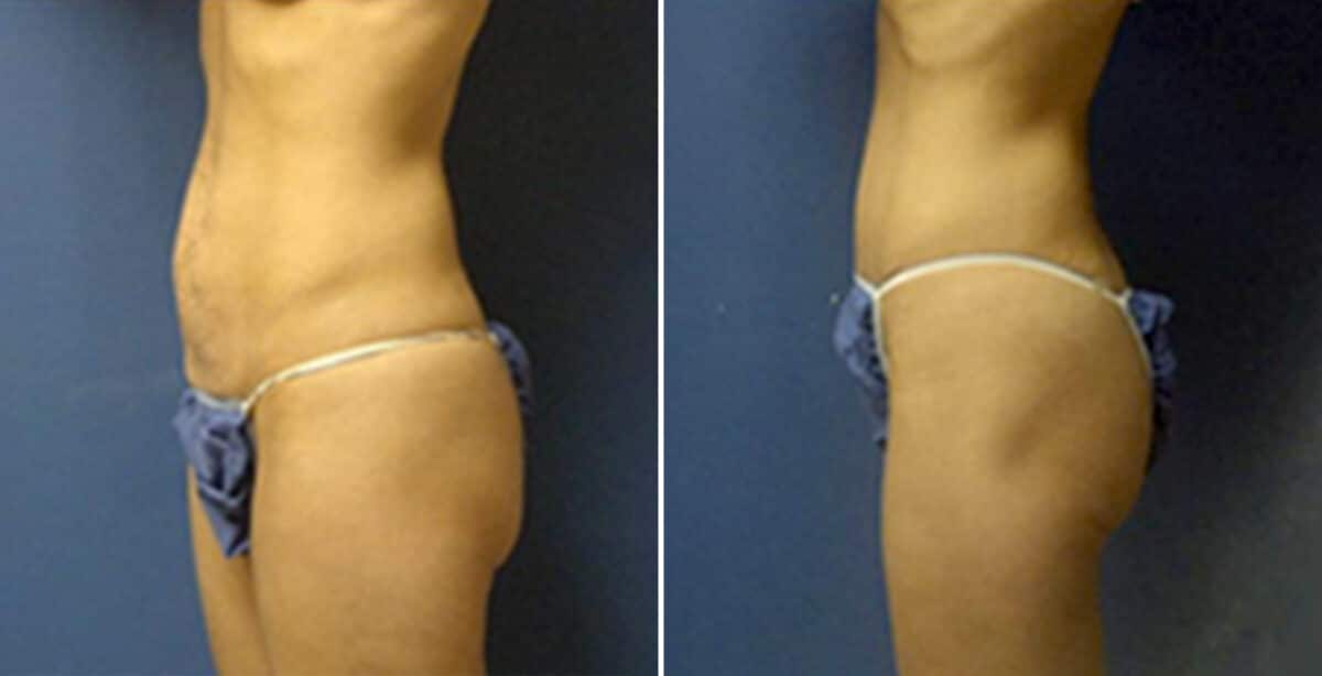 Tummy Tuck Before and After Photos in New York, NY, Patient 10514