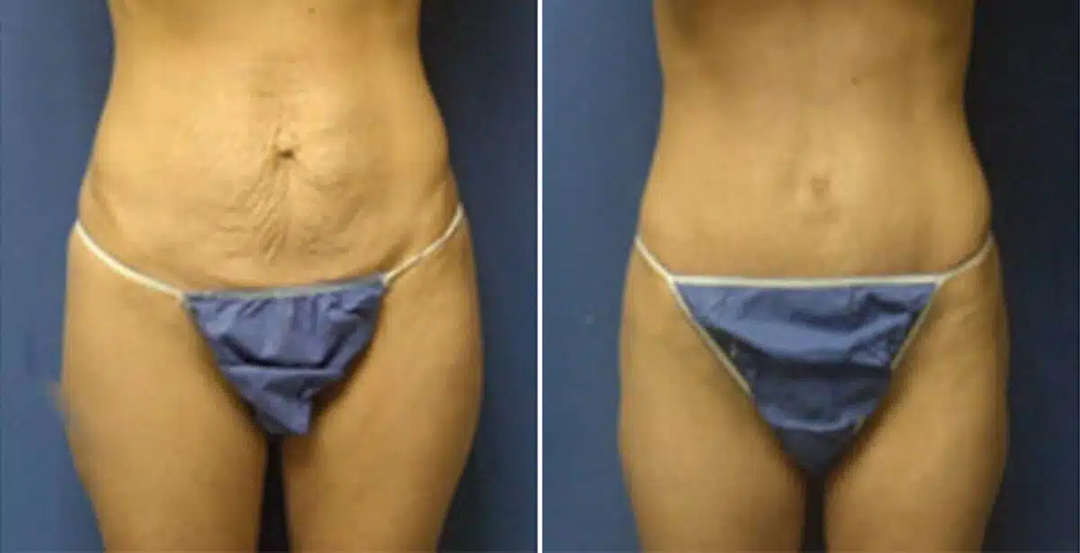 Tummy Tuck Before and After Photos in New York, NY, Patient 10514