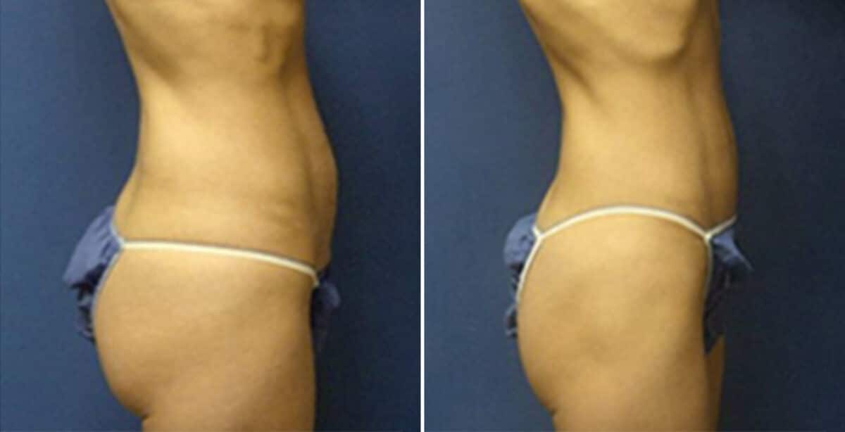 Tummy Tuck Before and After Photos in New York, NY, Patient 10514