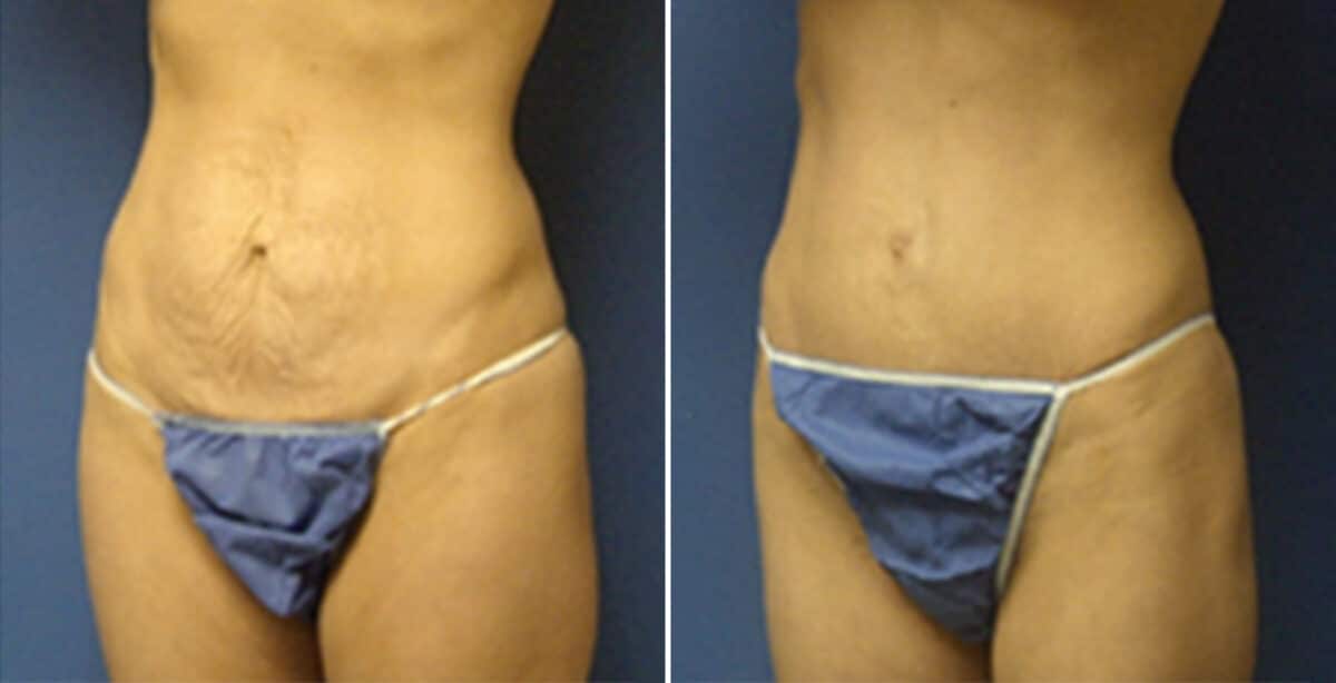 Tummy Tuck Before and After Photos in New York, NY, Patient 10514