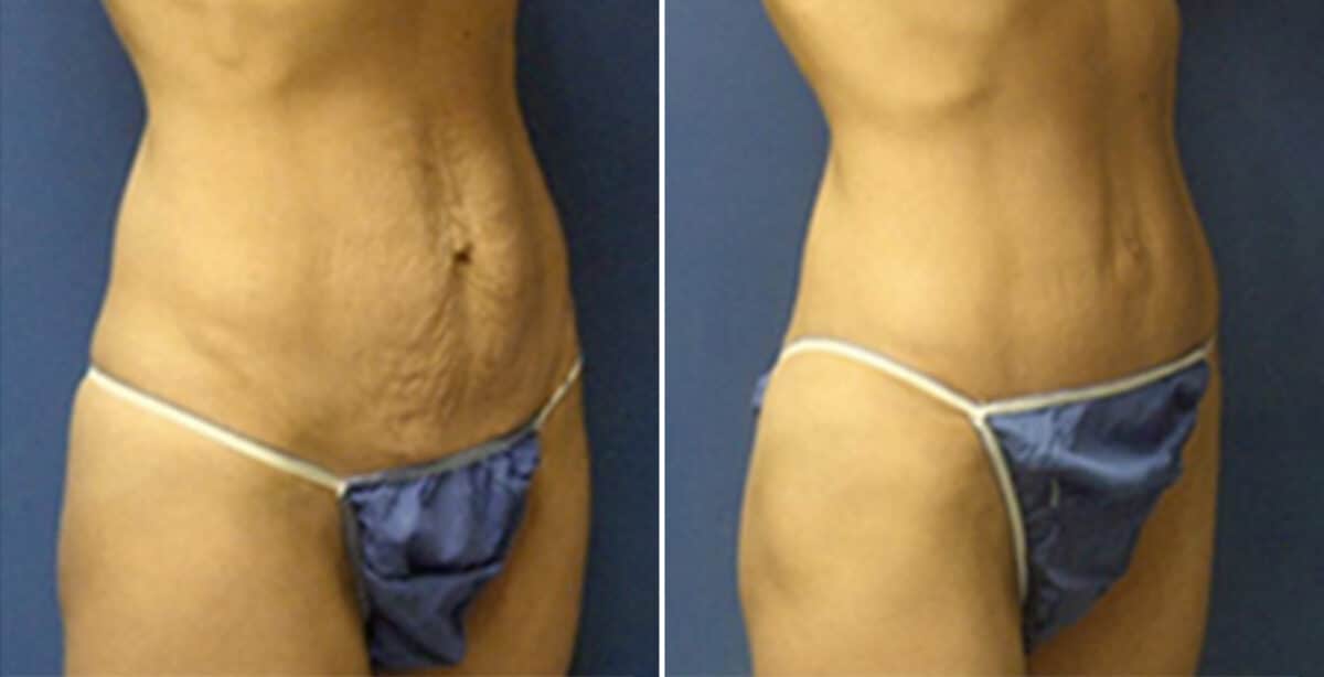 Tummy Tuck Before and After Photos in New York, NY, Patient 10514