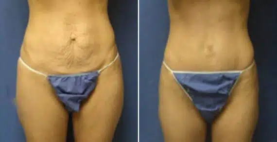 Tummy Tuck Before and After Photos in New York, NY, Patient 10514