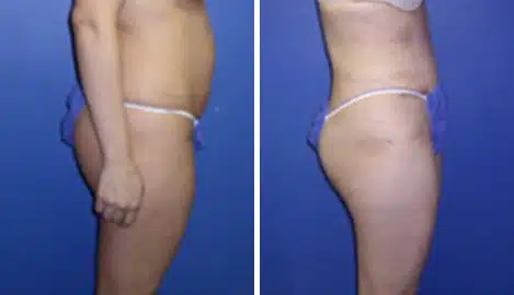 Tummy Tuck Before and After Photos in New York, NY, Patient 10552