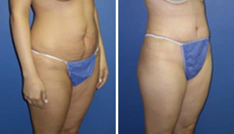 Tummy Tuck Before and After Photos in New York, NY, Patient 10552